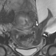 Scans revealed a tear in the uterus, with the baby’s feet sticking right into the amniotic sac. (Image: NEJM, Pierre-Emmanuel Bouet, Centre Hospitalier Universitaire d’Angers, Angers, France)